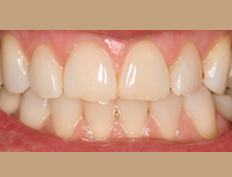 In office bleaching gives this smile a fresh and youthful appearance